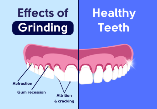 GrindGuard Plus | Grinding Mouth Guard