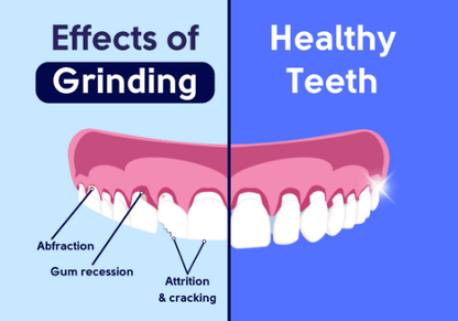 GrindGuard Plus | Grinding Mouth Guard